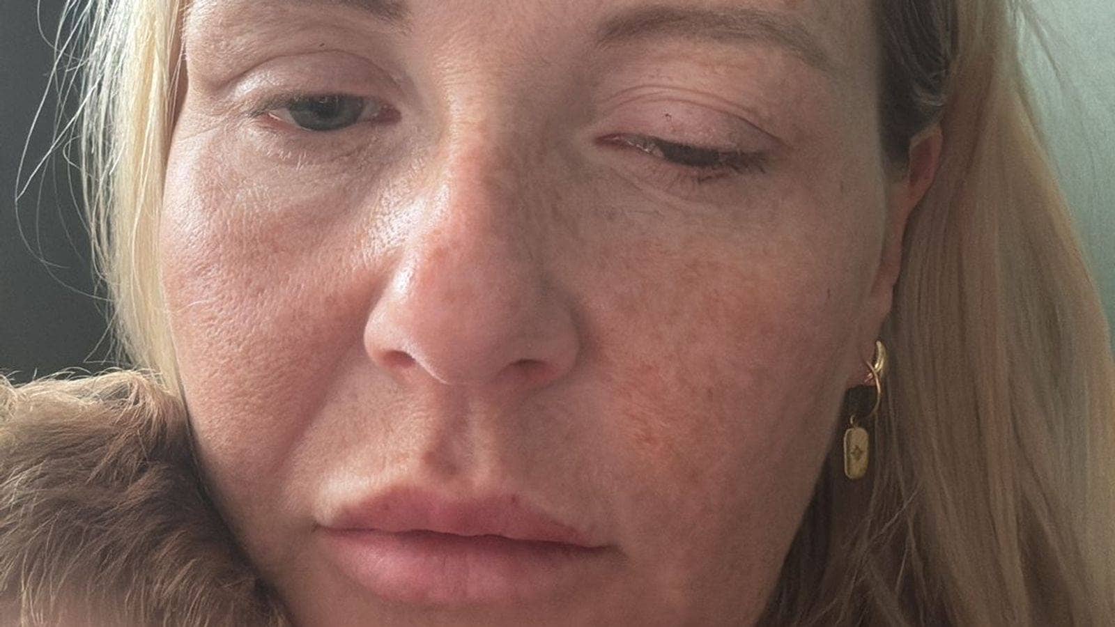 Botox-like injections spark outbreak of rare disease many doctors have never treated