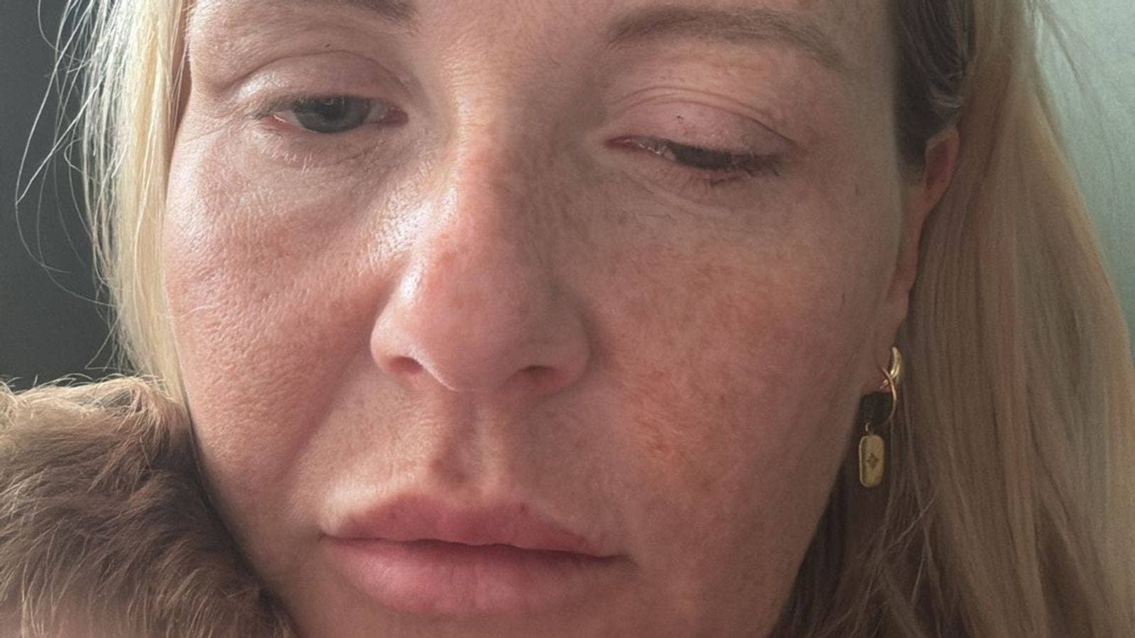 Botox-like injections spark outbreak of rare disease many doctors have never treated